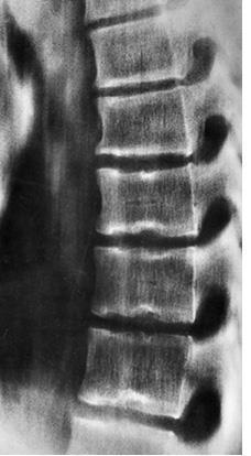 Thoracic Spine Conditions