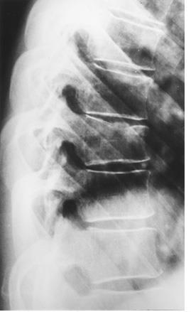 ) Thoracic spinal fractures