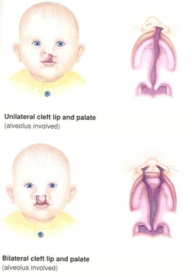 How does a cleft lip and palate occur? The lips and the palate form during the early stages of pregnancy. Initially they form as separate halves that join together.