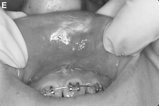 (C) Intraoral scaring and contracture