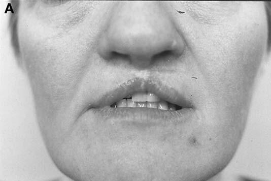 M. Cohen / Clin Plastic Surg 31 (2004) 331 345 337 Fig. 4. (A) Very short and tight upper lip after repair of bilateral cleft lip. (B) Markings for a proposed Abbe flap from the lower lip.