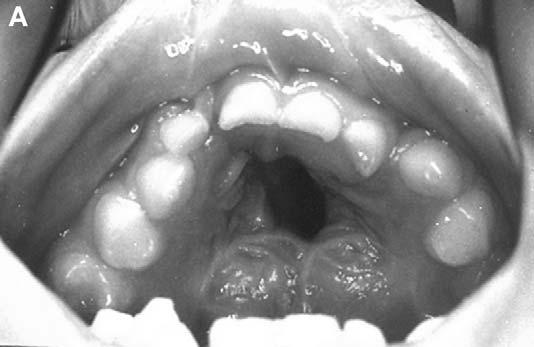 M. Cohen / Clin Plastic Surg 31 (2004) 331 345 339 incision in the hard palate and wide undermining of the palatal mucoperiosteum might facilitate closure.