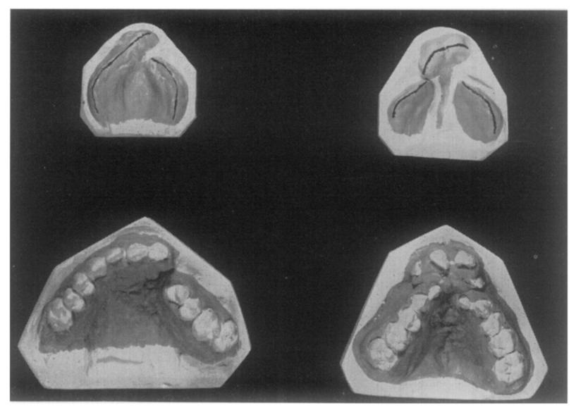 2 Models of four patients with unilateral and bilateral clefts of lip and palate, illustrating unilateral and bilateral " pre-operative " type of collapse, and showing how the ultimate collapse