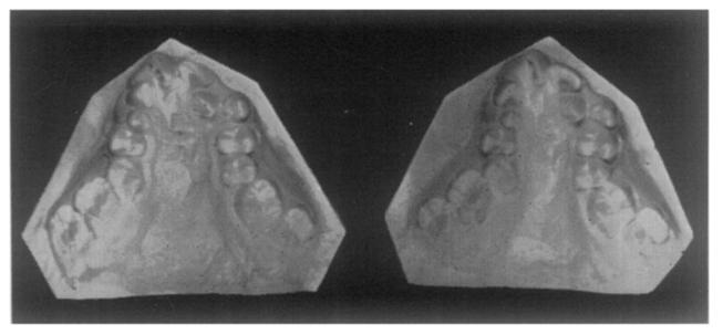 exhibited typical "pre-operative" collapse of the arches, "Buckling" Type of Collapse of the Arch.--The " buckling" type of collapse (see Fig.