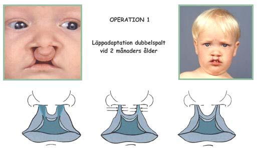 5. Bilateral clefts in the lip alveolus (jaw) and palate (BCLP): Lip adhesion is the first closure of the lip In complete bilateral cleft lip and palate the first operation takes place at 6 8 weeks