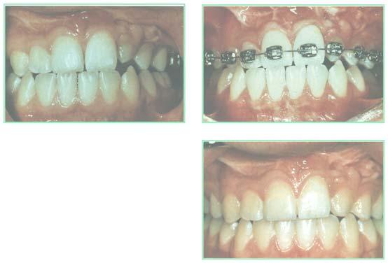 Teeth Orthodontic treatment will start at 7-8 years of age.