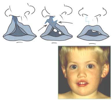 Surgery Surgery is performed in several steps and is somewhat different depending on the type of cleft. 1.