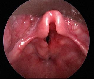 NASSERI et al. Brunei Int Med J. 2014; 10 (1): 56 Thoracic Inlet Fig. 1: The Benjamin Inglis classification system of laryngeal clefts.