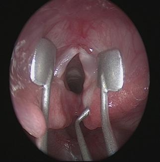 Type 2 clefts extend below the level of the vocal cords but do not involve the posterior cricoid lamina completely.