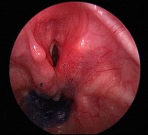 NASSERI et al. Brunei Int Med J. 2014; 10 (1): 57 cation by Stimulated Emission of Radiation) treatment to her inter-arytenoid area and redundant mucosa overlying the arytenoids.