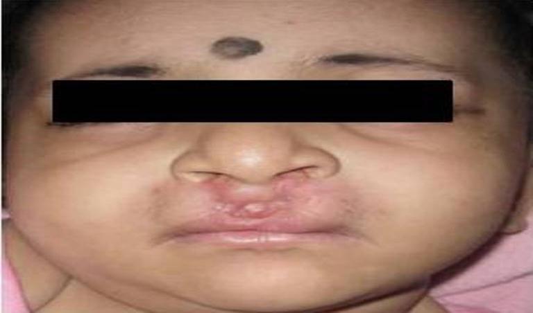 References: [1]. Ma X, Giacona MB. Nasoalveolar Molding as Treatment for Cleft Lip and Palate: A Case Report Columbia Dental Review. 13:20-24, 2009 [2]. Prasanth et al.