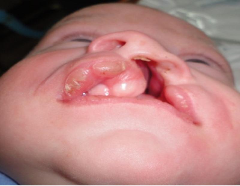 Complete closure of the lip is usually accomplished by 35 days post conception as the lateral nasal, median nasal, and maxillary mesodermal processes merge.