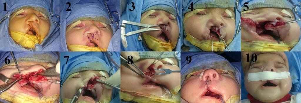 Figure 3: intra-operative steps of repair of unilateral cleft lip and nose. 3. Results This study included 40 patients with primary unilateral cleft lip.
