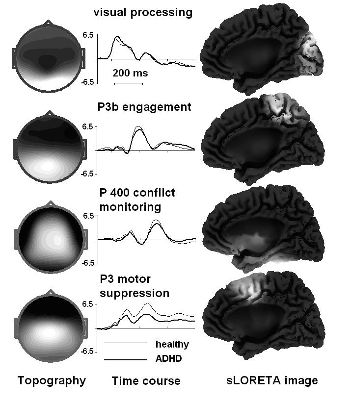 Fig. 5. Independent components of ERPs in response to NOGO cues in ADHD and healthy children.