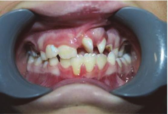 Objective To investigate the post-orthodontic stability of well aligned upper teeth in young cleft lip/ palate patients who had had bone grafts placed in the cleft