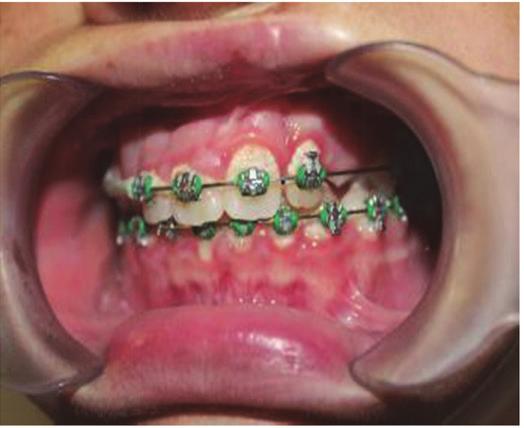 Materials and Methods The study involved an investigation of four cases which included two patients with unilateral cleft lip/ alveolus, one with a unilateral cleft