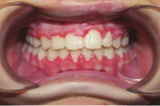 This is a photographic evaluation which depicts and records dental changes in the post orthodontic treatment phase (i.e. retention phase).