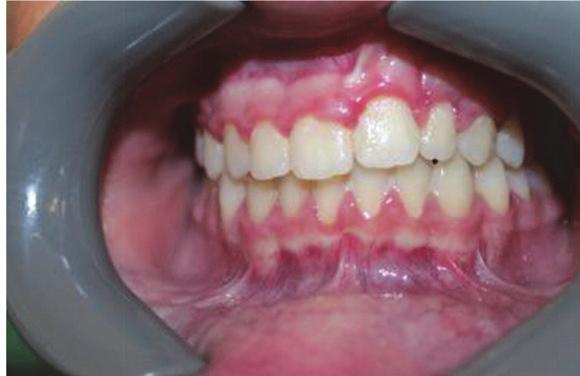 Debanding of patients refers to removal of fixed braces. The patients comprised three young females and one male. All are based in Kwa Zulu Natal, South Africa.