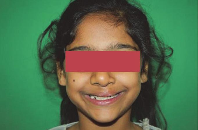 268 > Case 2: Unilateral Cleft Lip Alveolus This patient presented, as a young