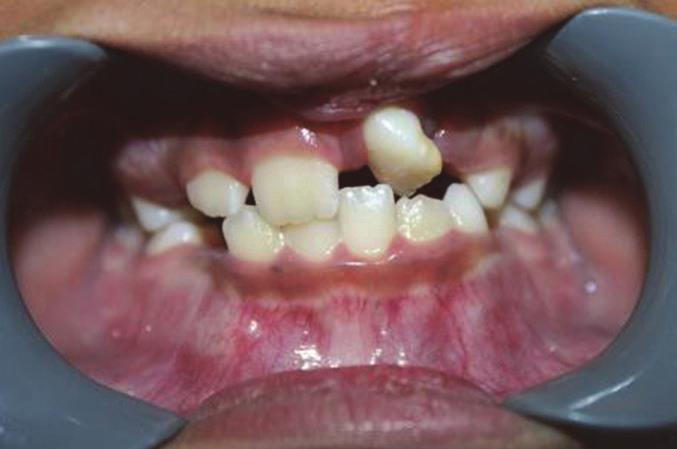Her cleft was on the left side with the lateral incisor on the distal aspect of