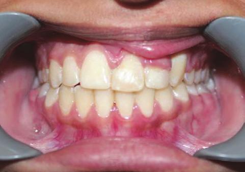 patient was one year into the fixed appliance orthodontic treatment (Figure 13