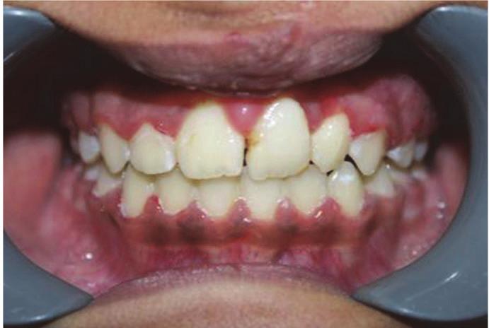 after initiation of the fixed appliance orthodontic treatment.