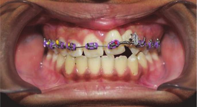 Figure 12B: Intra-oral pre-treatment.