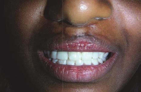 cleft lip/ palate with a Class 3 occlusion.