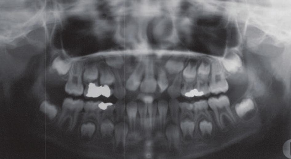 An iliac crest bone graft was placed during fixed orthodontic treatment.