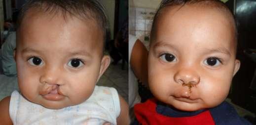 Cleft-palate and Other facial deformities.