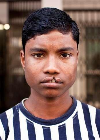 Biju was very happy when he was told that he would get surgery on the first day of the Mission at the MMC