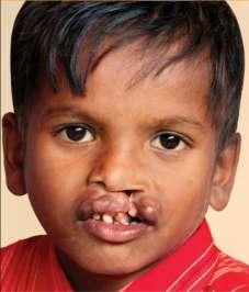 Cleft Births in India 35,000 Annual