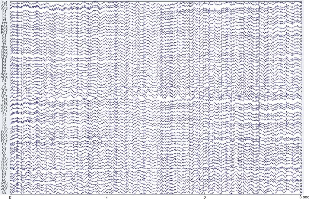Figure 1.2 EEG traces.