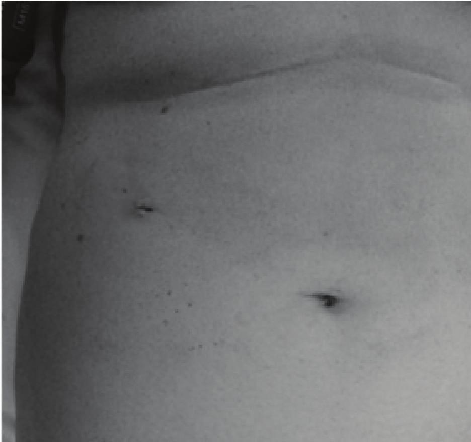 Case Reports in Surgery 3 Figure 3: Photograph showing the postoperative scars for the three 5 mm ports that were inserted into the abdomen.