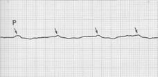 04mg/kg (average 3mg) Last of the rhythms: Asystole Forms of