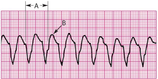 6. Atrial rate: Ventricular rate: P waves: QRS: Intervals: Obscured (see discussion below) Regular; R to R intervals are regular, >150 bpm Obscured (see discussion below) Wide and bizarre, unchanged