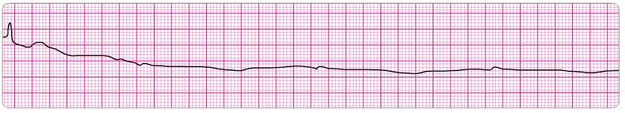 7. Atrial rate: Ventricular rate: P waves: QRS: Intervals: Absent Absent Absent Absent PR: absent QRS: