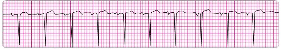 1. Atrial rate: Ventricular rate: P waves: QRS: Intervals: Regular; P to P is regular, 60 100 bpm Regular; R to R is regular, 60 100 bpm P wave before every QRS complex Unchanged unless