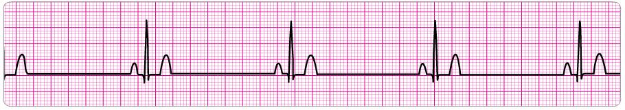 2. Atrial rate: Ventricular rate: P waves: QRS: Intervals: Regular; P to P is regular, <60