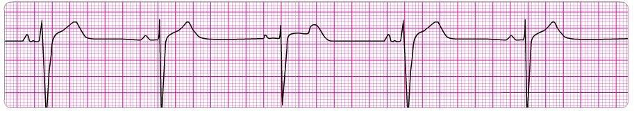 aberrant conduction due to premature beat or increased rate PR: 0.12-0.20 sec QRS: <0.