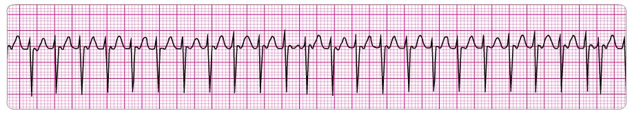 4. Atrial rate: Ventricular rate: P waves: QRS: Intervals: Regular; P to P