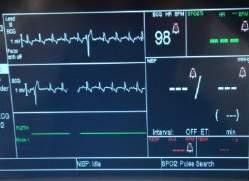 Monitoring Equipment Electrocardiogram (ECG) Subject to artifact during CPR Quickly evaluate during intercycle pauses