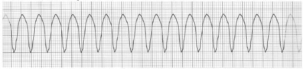 Defibrillation Shockable rhythms Ventricular fibrillation Pulseless