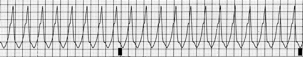 VENTRICULAR TACHYCARDIA (VT) Characteristics - Ventricular Tachycardia is a wide complex regular tachycardia - Rhythm originates in the ventricles - Usually occurs as a result of an irritable