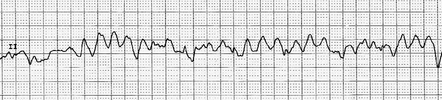 VENTRICULAR FIBRILLATION (VF) Characteristics - Ventricular Fibrillation is chaotic ventricular activity that produces no cardiac output - Irregular and disorganised electrical activity - Rarely is