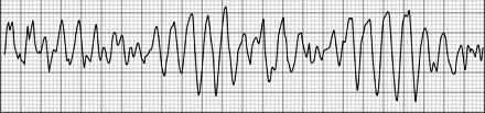 TORSADE d POINTES Characteristics - Polymorphic Ventricular Tachycardia (VT) - Twisting of the Points - QRS complexes appear to twist or undulate around the isoelectric line - Associated with a