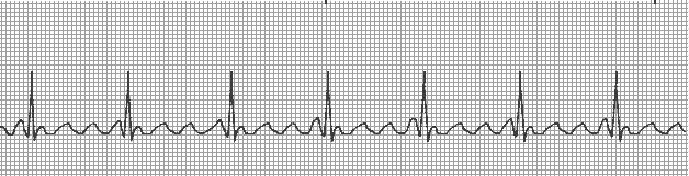ATRIAL FLUTTER Characteristics - Atria are depolarised at a rate of approximately 300 times per minute - Waveforms that resemble saw teeth flutter waves - AV node only conducts some of the impulses