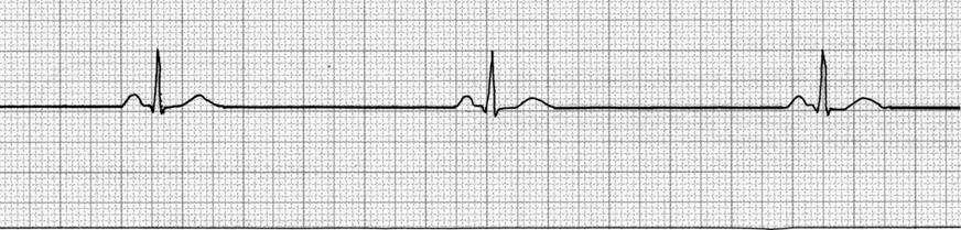 SINUS BRADYCARDIA Characteristics - Caused by increased vagal stimulation or decreased sympathetic tone - Increased ventricular filling time due to prolonged diastole - Relatively benign rhythm -