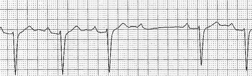 2 ND DEGREE TYPE II AV BLOCK (MOBITZ II) Characteristics - Not all atrial impulses are conducted through to the ventricles - Occurs in the Bundle of His or bundle branches - Manifests in two ways: