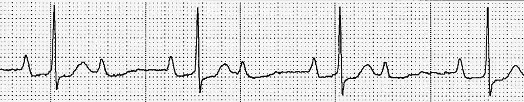 2:1 AV BLOCK Characteristics - Conduction ratio is 2:1 (number of P waves to QRS complexes) - May involve the AV Node or Sub-Nodal tissue - May be associated with Inferior MI (AV Node) or Anterior MI